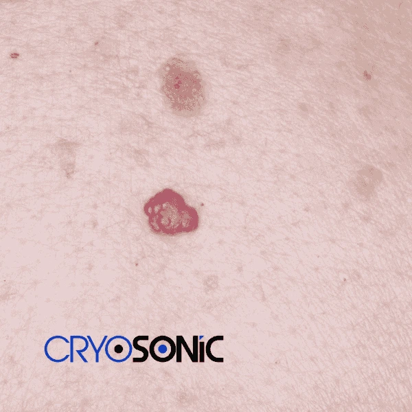Looking for pain free cherry angioma removal treatment Sheffield? Call our team today! Sheffield