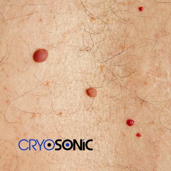 get cherry angioma removal treatment today! Sheffield