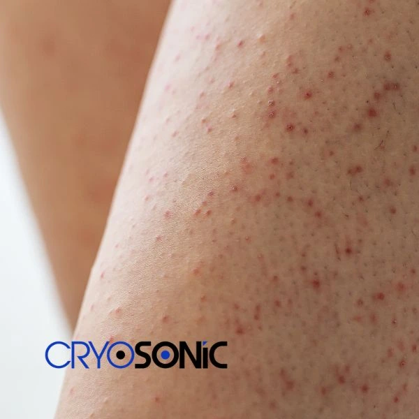 Looking for Seborrhoeic Keratosis removal Sheffield treatment? Call our consultants today in Sheffield