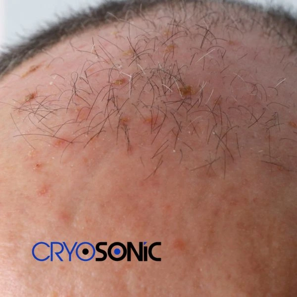 Access Seborrhoeic Keratosis removal from the comfort of your own home! Call us today in Sheffield