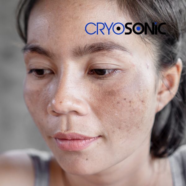 Ready to start age spots removal? Contact our team today in Sheffield