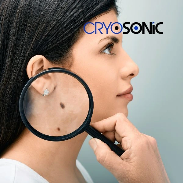 Do you want to learn more about benign moles removal treatment? Call our team today Sheffield
