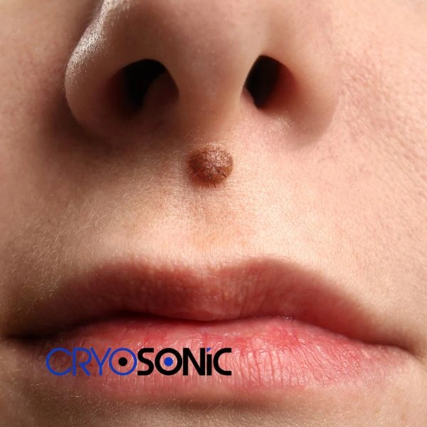Start your benign moles removal treatment today Sheffield