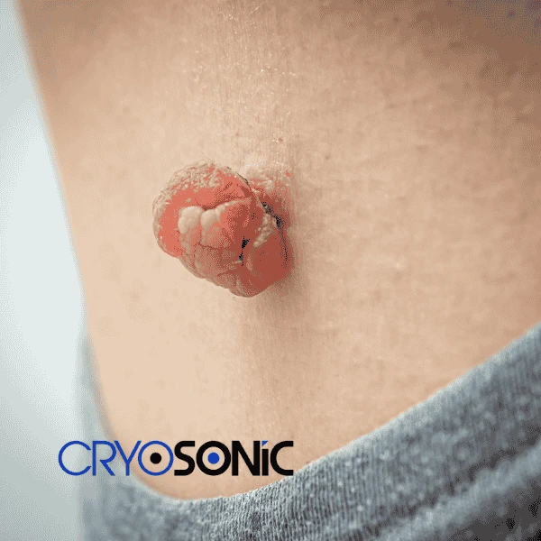 Book your skin tags removal Sheffield from comfort of your own home! Sheffield
