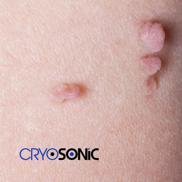 Are you looking for fast effect skin tag removal Sheffield? Book in NOW! Sheffield