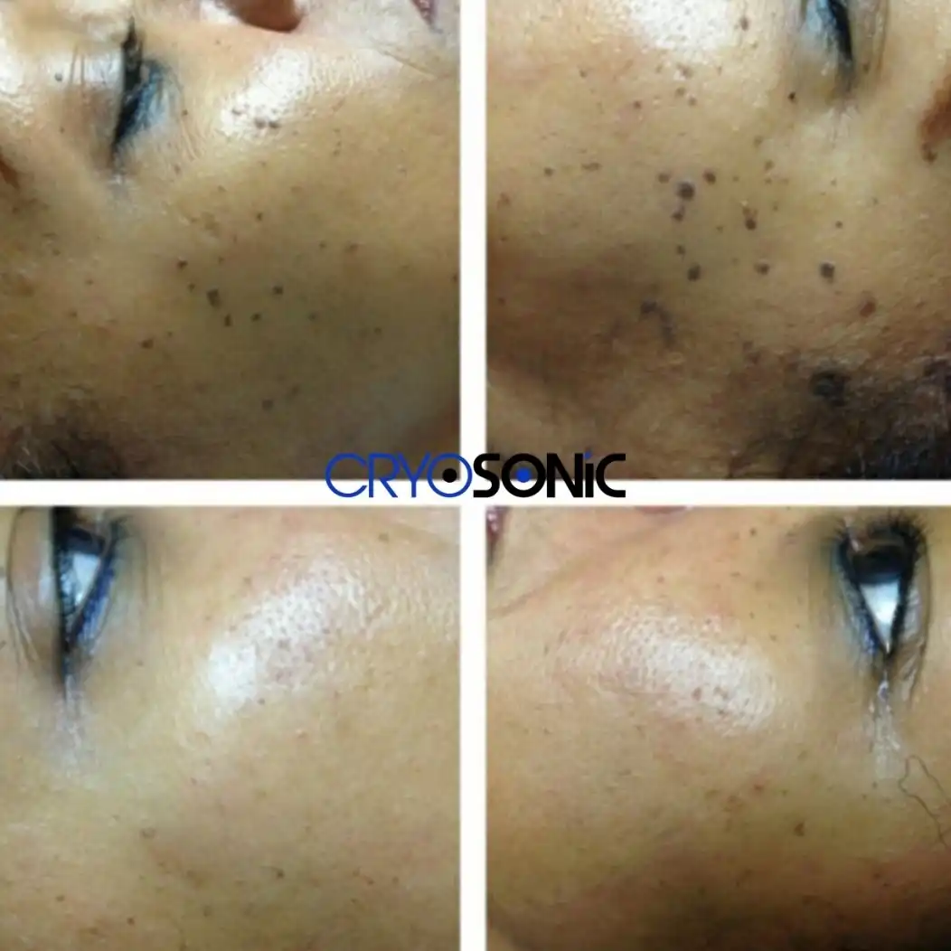 Why Skin Shows Pigmentation After Treatment Sheffield