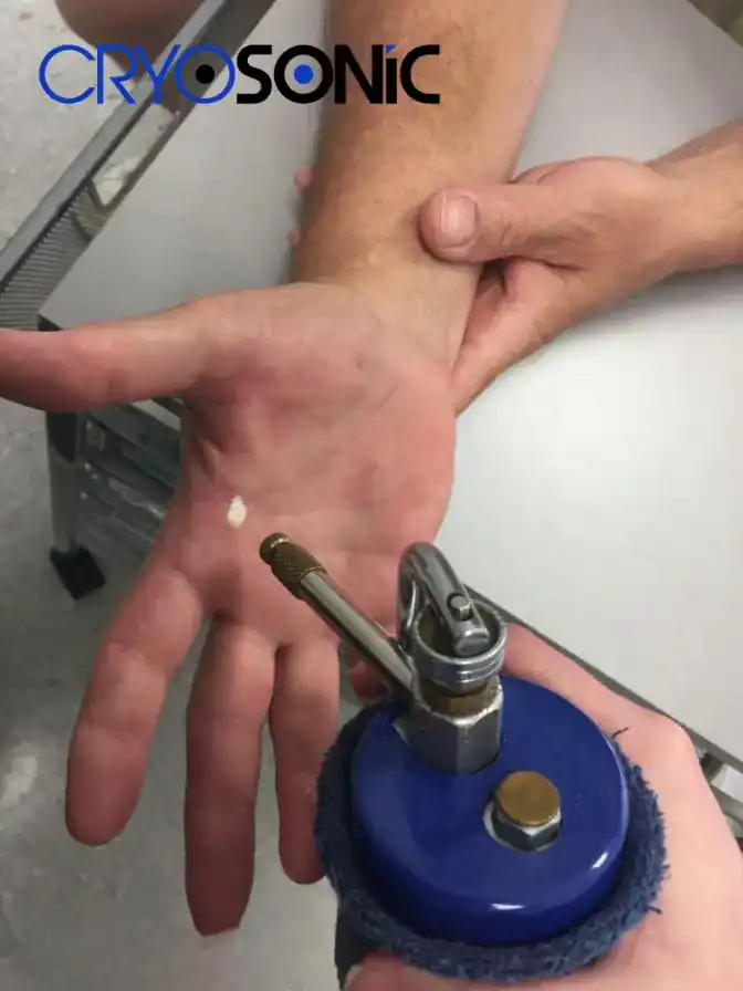 Temperature Differences: OTC vs Medical-Grade Cryotherapy Sheffield